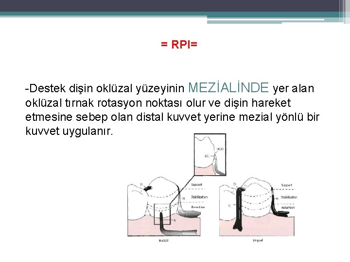 = RPI= -Destek dişin oklüzal yüzeyinin MEZİALİNDE yer alan oklüzal tırnak rotasyon noktası olur