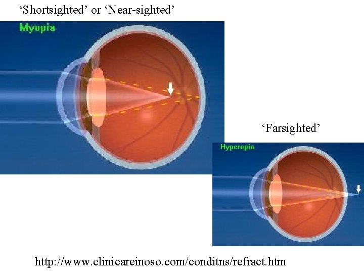 ‘Shortsighted’ or ‘Near-sighted’ ‘Farsighted’ http: //www. clinicareinoso. com/conditns/refract. htm 