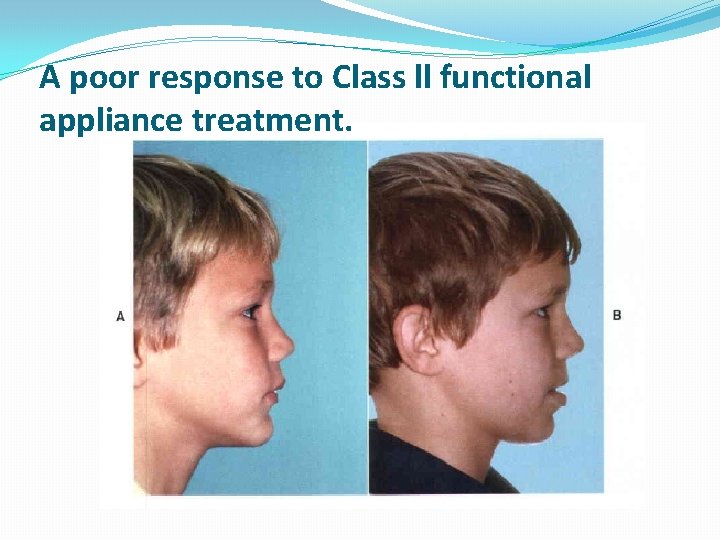 A poor response to Class ll functional appliance treatment. 