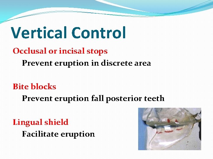 Vertical Control Occlusal or incisal stops Prevent eruption in discrete area Bite blocks Prevent