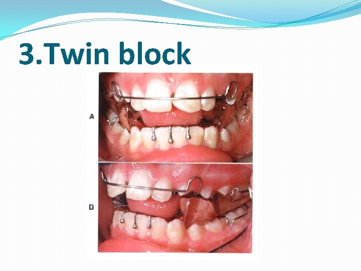 3. Twin block 