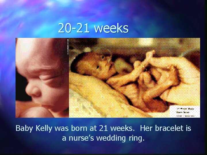 20 -21 weeks Baby Kelly was born at 21 weeks. Her bracelet is a