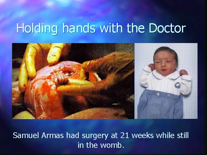 Holding hands with the Doctor Samuel Armas had surgery at 21 weeks while still