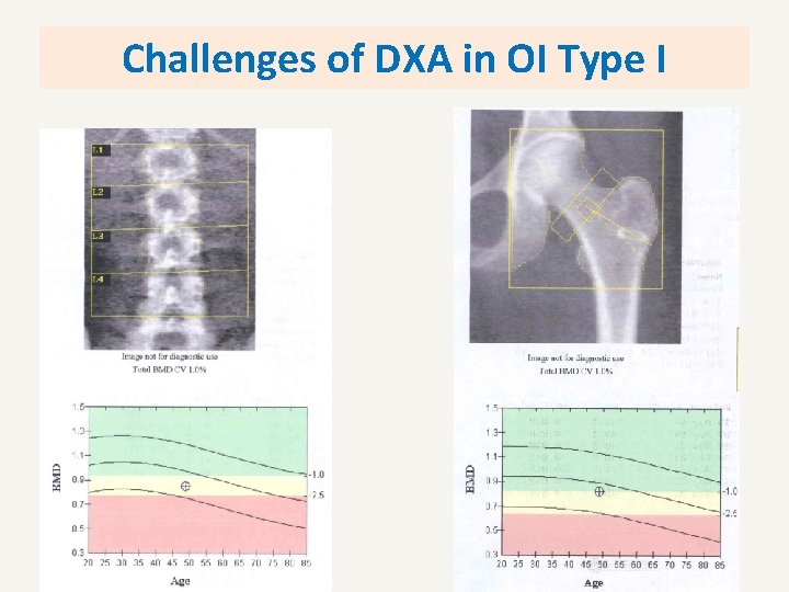 Challenges of DXA in OI Type I 