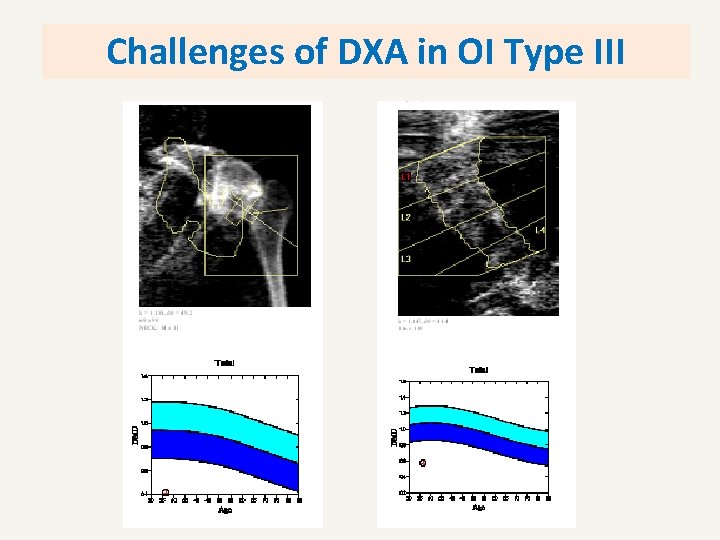 Challenges of DXA in OI Type III 