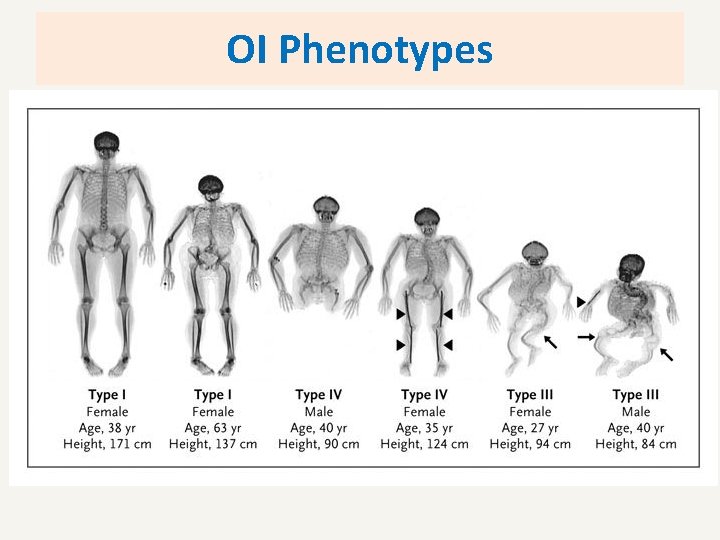 OI Phenotypes 