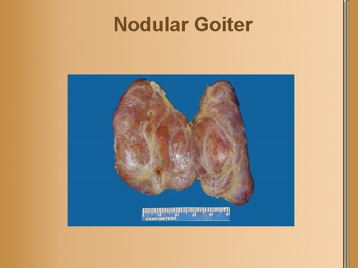 Nodular Goiter 