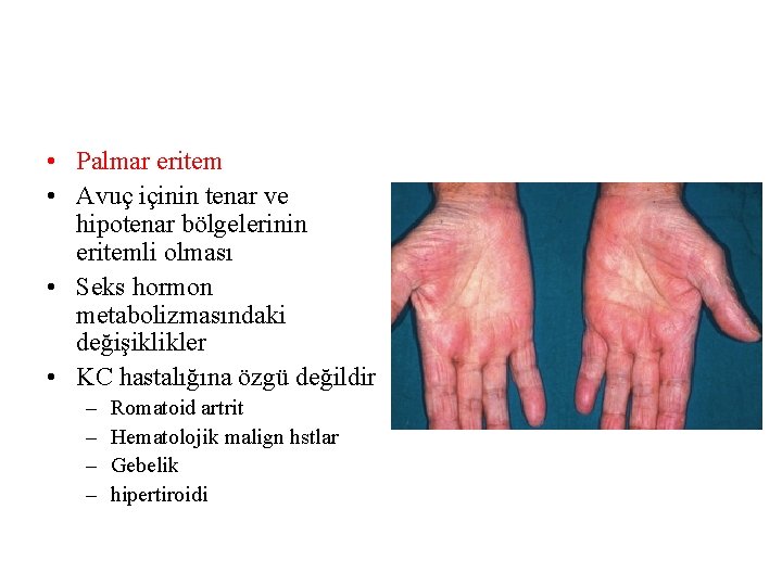  • Palmar eritem • Avuç içinin tenar ve hipotenar bölgelerinin eritemli olması •