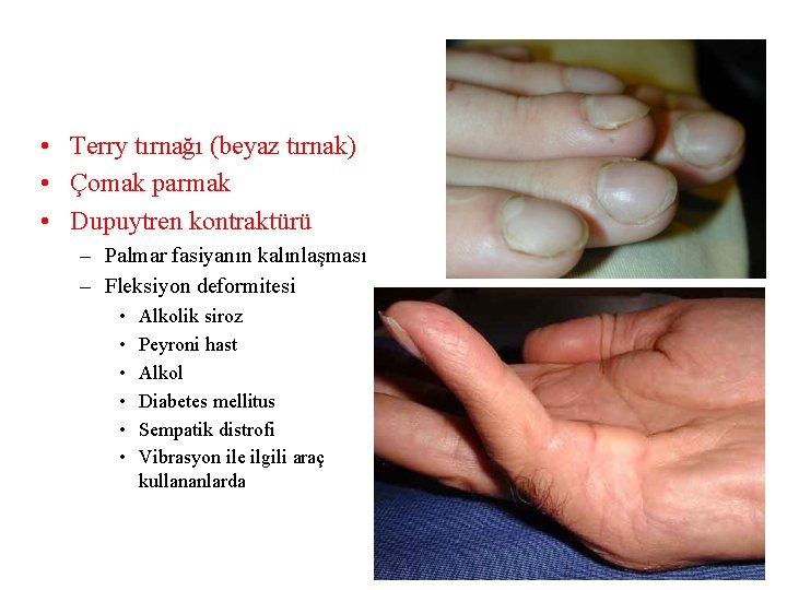  • Terry tırnağı (beyaz tırnak) • Çomak parmak • Dupuytren kontraktürü – Palmar