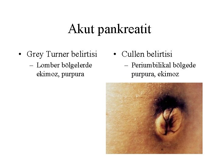 Akut pankreatit • Grey Turner belirtisi – Lomber bölgelerde ekimoz, purpura • Cullen belirtisi