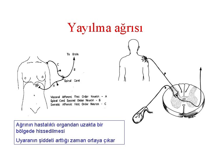 Yayılma ağrısı Ağrının hastalıklı organdan uzakta bir bölgede hissedilmesi Uyaranın şiddeti arttığı zaman ortaya