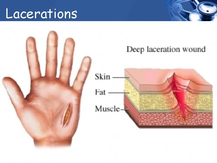 Lacerations 