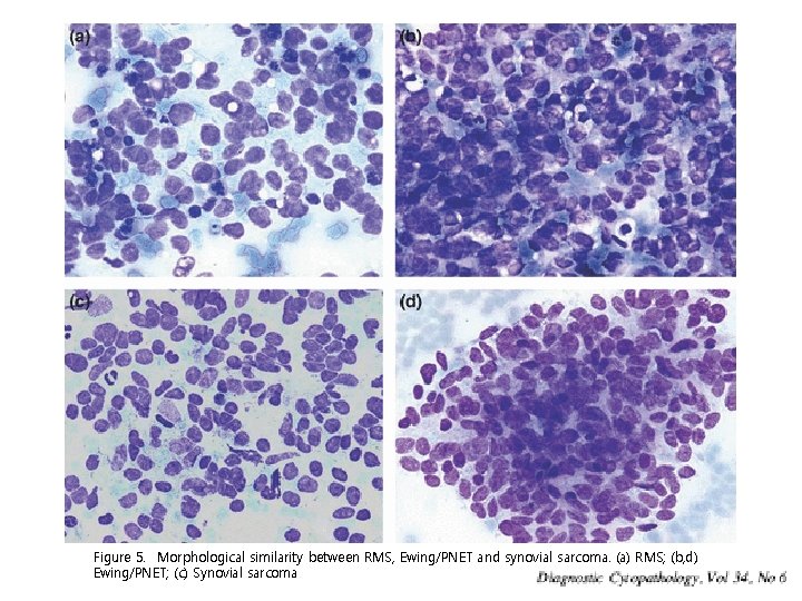 Figure 5. Morphological similarity between RMS, Ewing/PNET and synovial sarcoma. (a) RMS; (b, d)