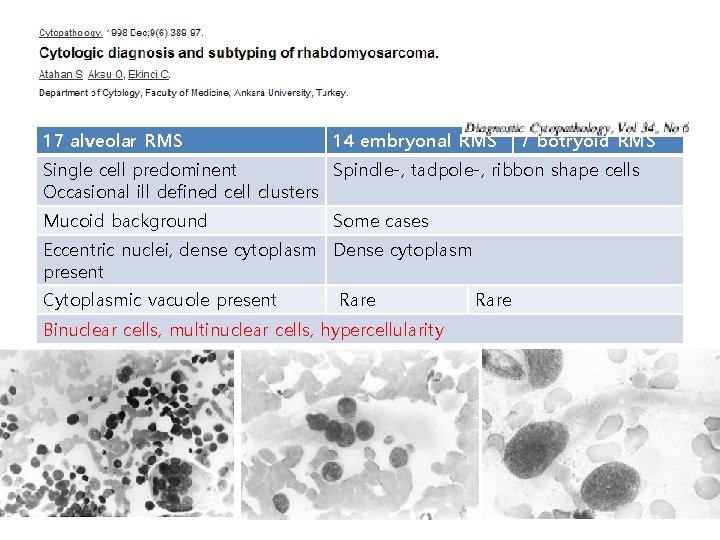 17 alveolar RMS 14 embryonal RMS 7 botryoid RMS Single cell predominent Spindle-, tadpole-,