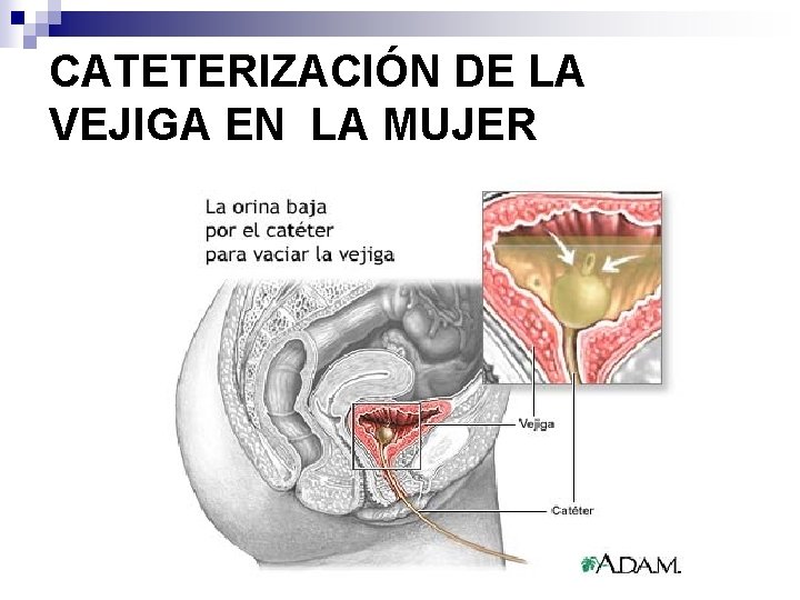 CATETERIZACIÓN DE LA VEJIGA EN LA MUJER 