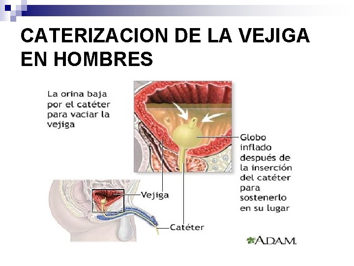 CATERIZACION DE LA VEJIGA EN HOMBRES 