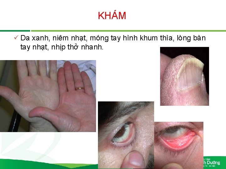 KHÁM ü Da xanh, niêm nhạt, móng tay hình khum thìa, lòng bàn tay