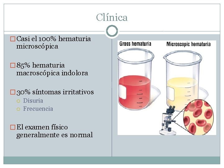 Clínica � Casi el 100% hematuria microscópica � 85% hematuria macroscópica indolora � 30%