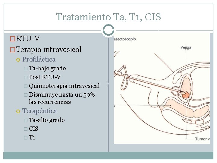 Tratamiento Ta, T 1, CIS �RTU-V �Terapia intravesical Profiláctica � Ta-bajo grado � Post