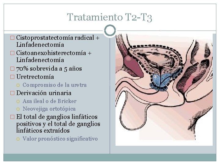Tratamiento T 2 -T 3 � Cistoprostatectomía radical + Linfadenectomía � Cistoanexohisterectomía + Linfadenectomía