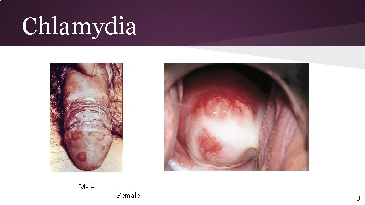 Chlamydia Male Female 3 