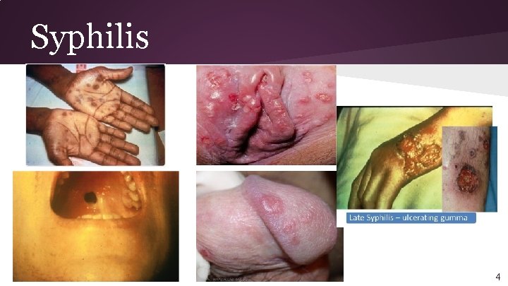 Syphilis 4 