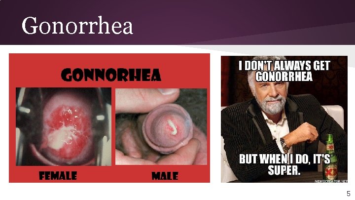 Gonorrhea 5 