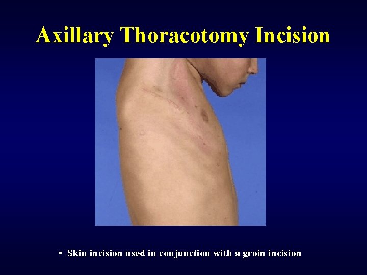 Axillary Thoracotomy Incision • Skin incision used in conjunction with a groin incision 