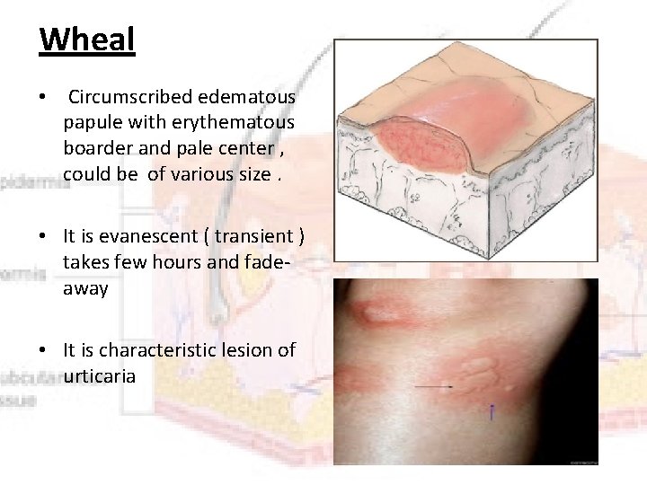 Wheal • Circumscribed edematous papule with erythematous boarder and pale center , could be