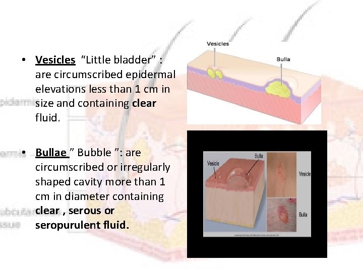  • Vesicles “Little bladder” : are circumscribed epidermal elevations less than 1 cm