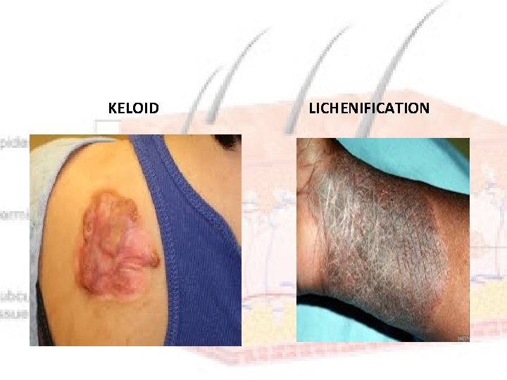 KELOID LICHENIFICATION 