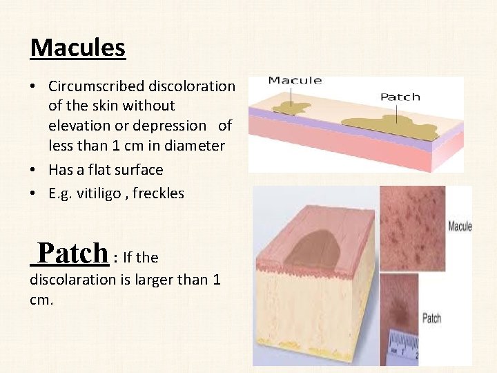 Macules • Circumscribed discoloration of the skin without elevation or depression of less than