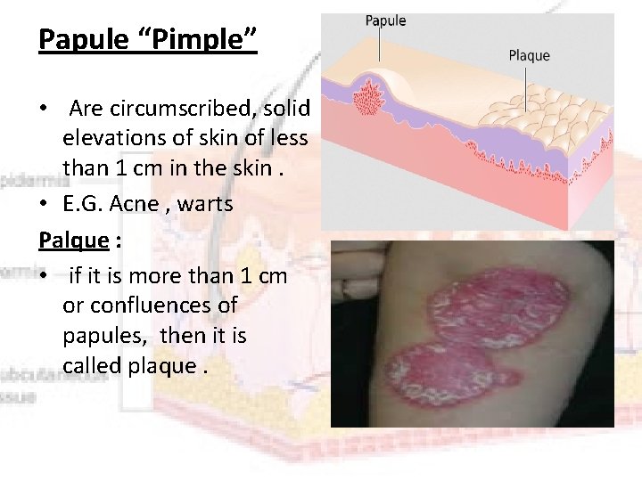 Papule “Pimple” • Are circumscribed, solid elevations of skin of less than 1 cm