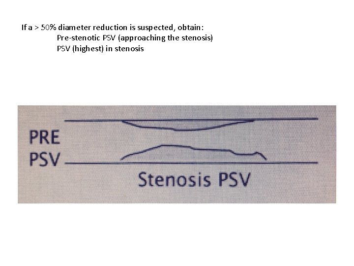 If a > 50% diameter reduction is suspected, obtain: Pre-stenotic PSV (approaching the stenosis)