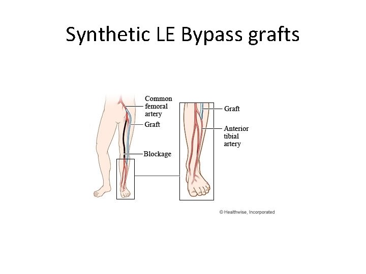 Synthetic LE Bypass grafts 