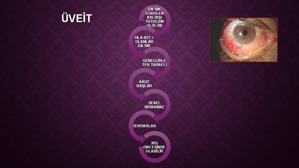 ÜVEİT EN SIK GÖRÜLEN KIS DIŞI TUTULUM (%25 -30) HLA B 27 + OLANLAR