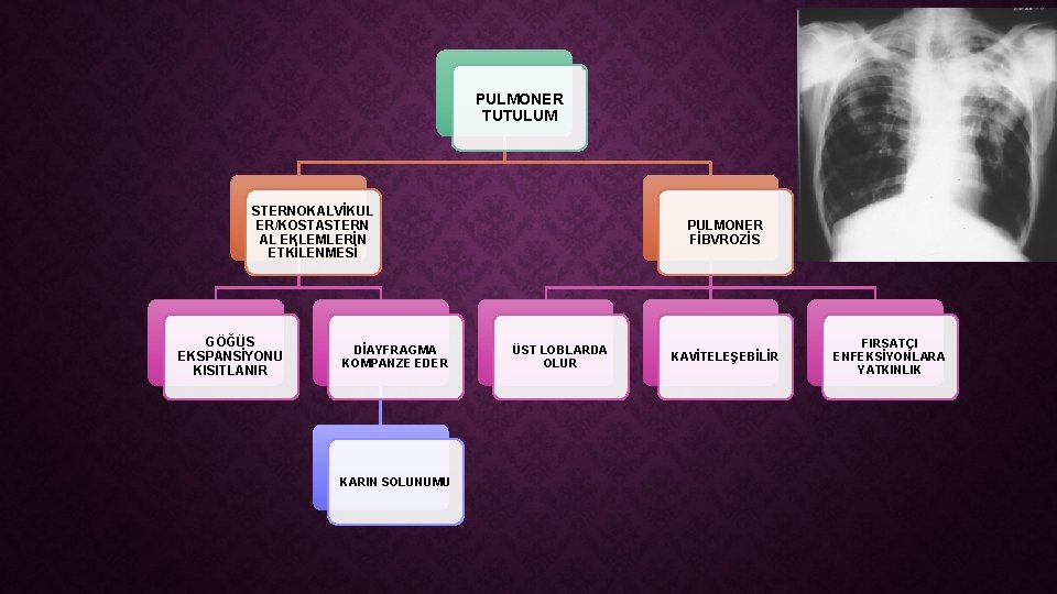 PULMONER TUTULUM STERNOKALVİKUL ER/KOSTASTERN AL EKLEMLERİN ETKİLENMESİ GÖĞÜS EKSPANSİYONU KISITLANIR DİAYFRAGMA KOMPANZE EDER KARIN