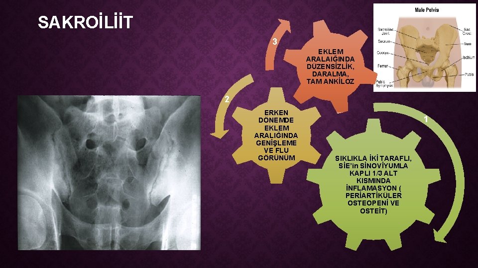 SAKROİLİİT 3 EKLEM ARALAIĞINDA DÜZENSİZLİK, DARALMA, TAM ANKİLOZ 2 ERKEN DÖNEMDE EKLEM ARALIĞINDA GENİŞLEME