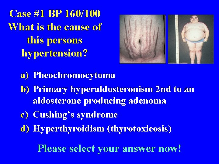 Case #1 BP 160/100 What is the cause of this persons hypertension? a) Pheochromocytoma