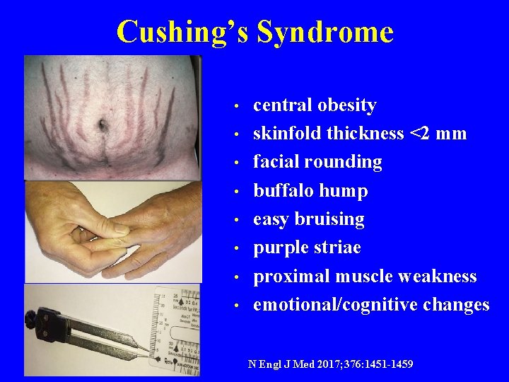 Cushing’s Syndrome • • central obesity skinfold thickness <2 mm facial rounding buffalo hump