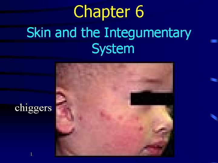 Chapter 6 Skin and the Integumentary System chiggers