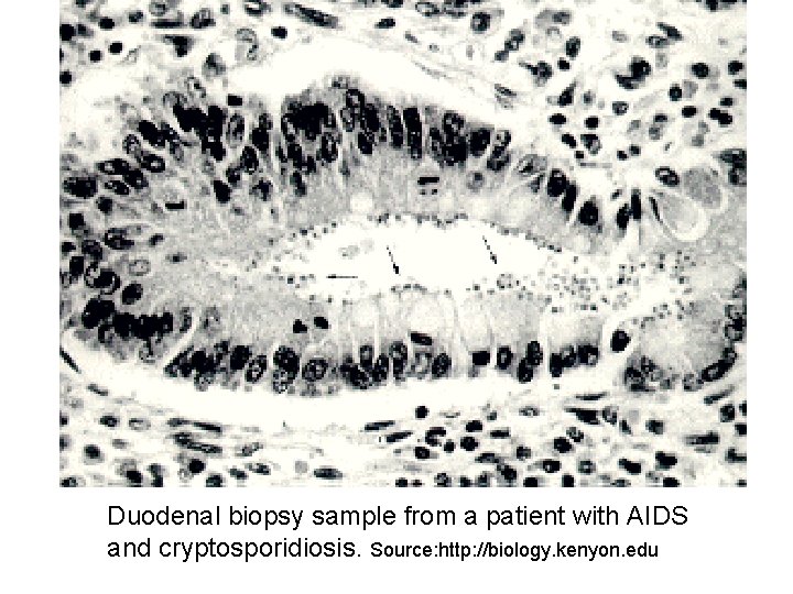 Duodenal biopsy sample from a patient with AIDS and cryptosporidiosis. Source: http: //biology. kenyon.