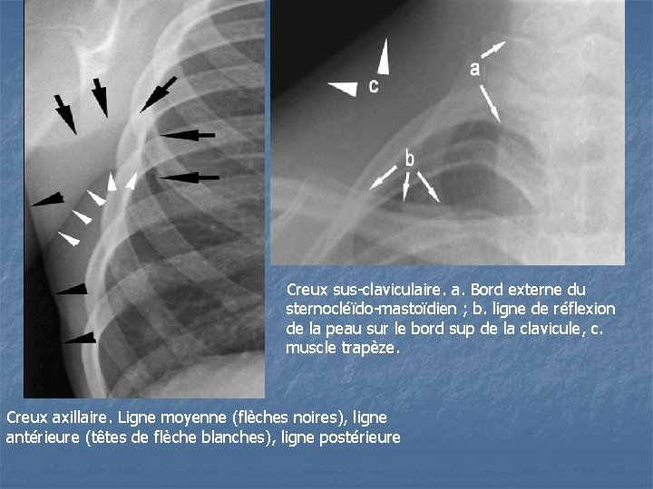 Creux sus-claviculaire. a. Bord externe du sternocléïdo-mastoïdien ; b. ligne de réflexion de la Creux sus-claviculaire. a. Bord externe du sternocléïdo-mastoïdien ; b. ligne de réflexion de la