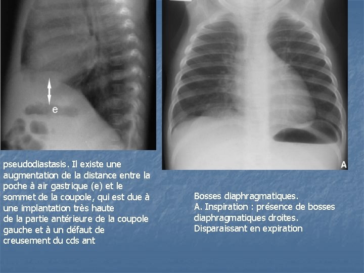 pseudodiastasis. Il existe une augmentation de la distance entre la poche à air gastrique pseudodiastasis. Il existe une augmentation de la distance entre la poche à air gastrique