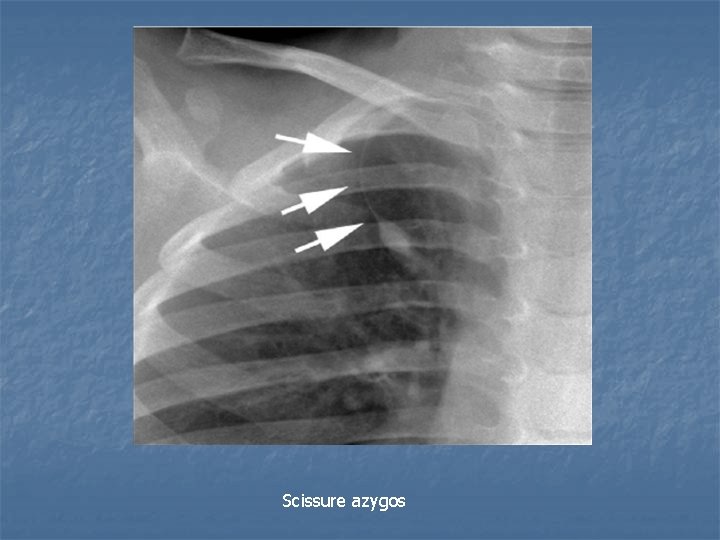 Scissure azygos Scissure azygos