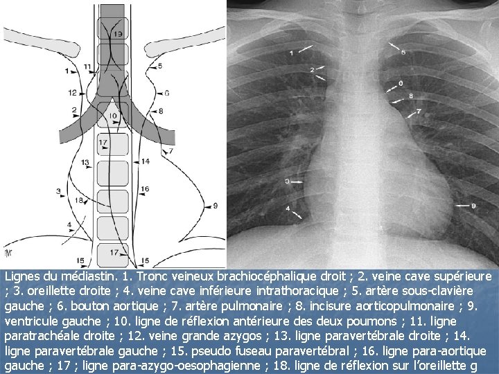 Lignes du médiastin. 1. Tronc veineux brachiocéphalique droit ; 2. veine cave supérieure ; Lignes du médiastin. 1. Tronc veineux brachiocéphalique droit ; 2. veine cave supérieure ;
