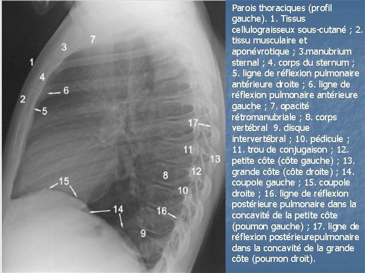 Parois thoraciques (profil gauche). 1. Tissus cellulograisseux sous-cutané ; 2. tissu musculaire et aponévrotique Parois thoraciques (profil gauche). 1. Tissus cellulograisseux sous-cutané ; 2. tissu musculaire et aponévrotique