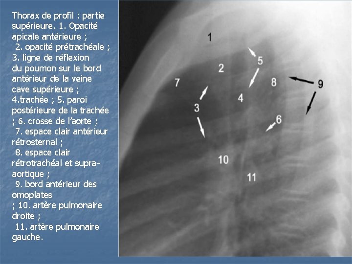 Thorax de profil : partie supérieure. 1. Opacité apicale antérieure ; 2. opacité prétrachéale Thorax de profil : partie supérieure. 1. Opacité apicale antérieure ; 2. opacité prétrachéale