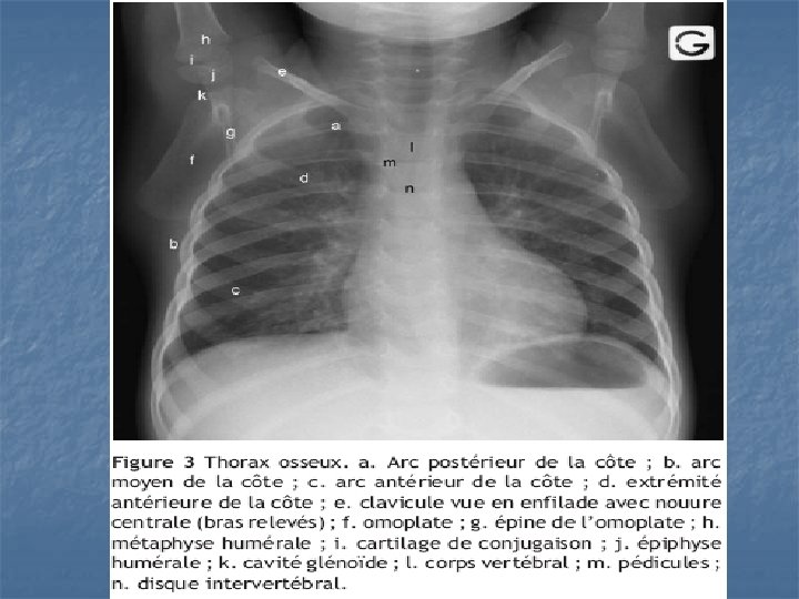 Radioanatomie Du Thorax Introduction N N La Connaissance