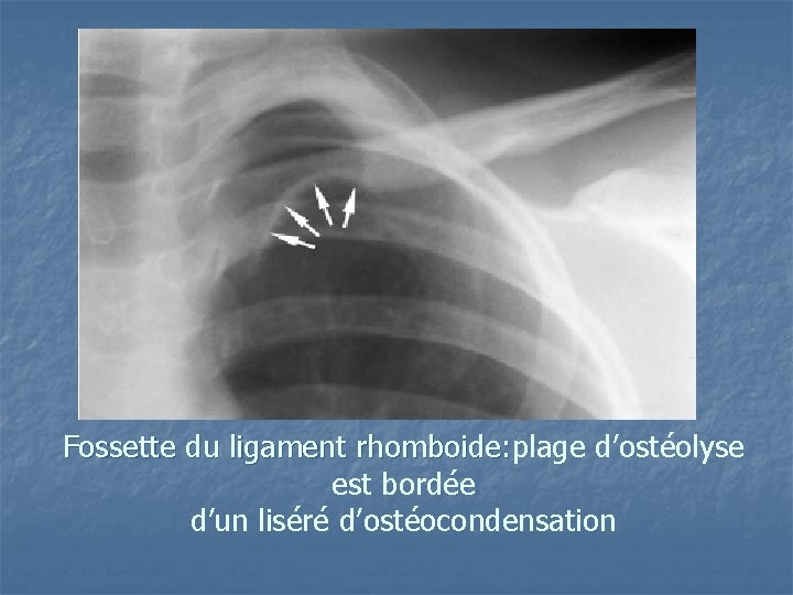Fossette du ligament rhomboide: plage d’ostéolyse est bordée d’un liséré d’ostéocondensation Fossette du ligament rhomboide: plage d’ostéolyse est bordée d’un liséré d’ostéocondensation